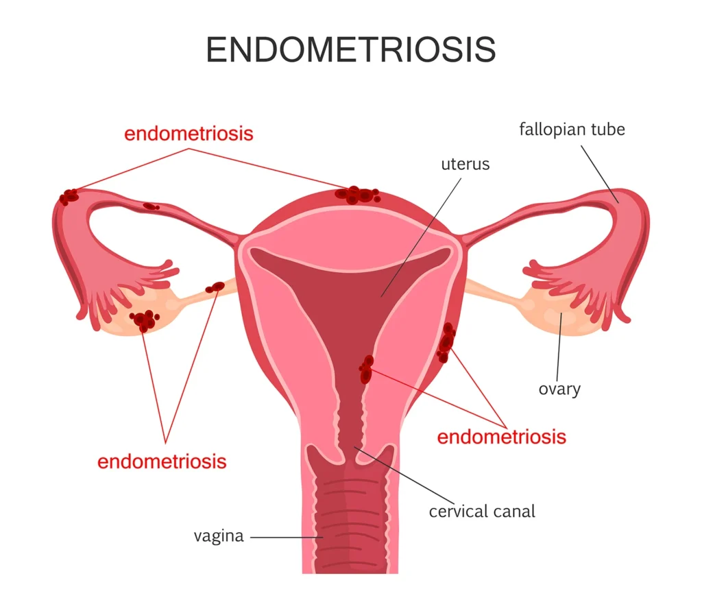 What is Endometriosis, and How Does It Impact Fertility